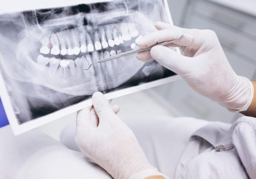 X-ray of teeth